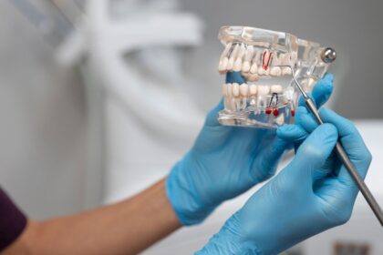 Musi sa trhat zuby mudrosti zubarka vysvetluje kedy je to nevyhnutne