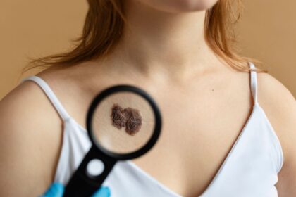 Nenapadny signal na pokozke moze odhalit rakovinu zaludka Mozete ho vidiet uz na zaciatku ochorenia