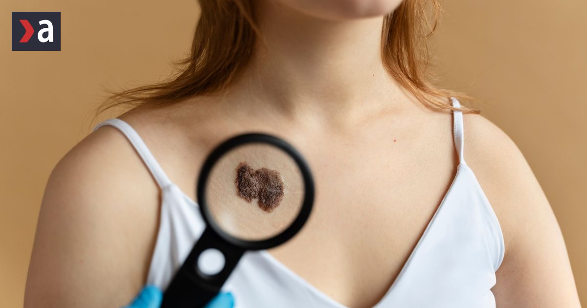 Nenapadny signal na pokozke moze odhalit rakovinu zaludka Mozete ho vidiet uz na zaciatku ochorenia